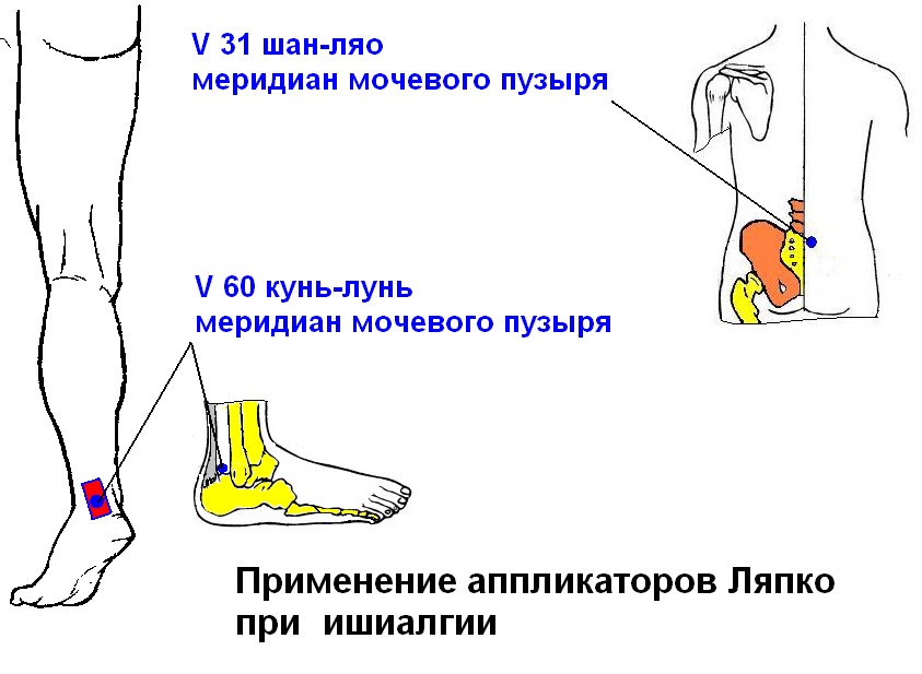 Остеохондроз плеча и его лечение народными средствами